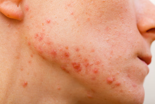 acne skin acne skin